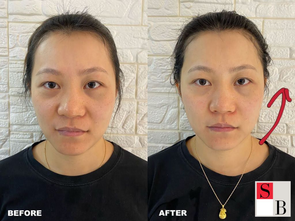 Real Results: The Transformative Benefits of Microneedling in Singapore