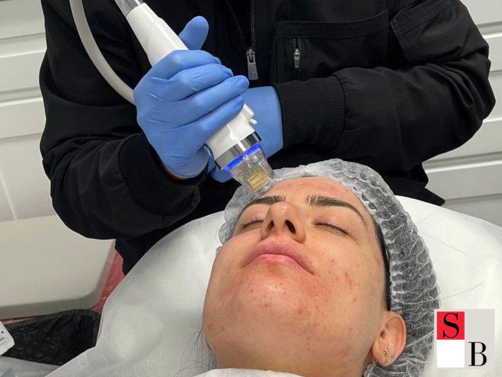 Benefits of Combining RF Microneedling with Other Skincare Treatments