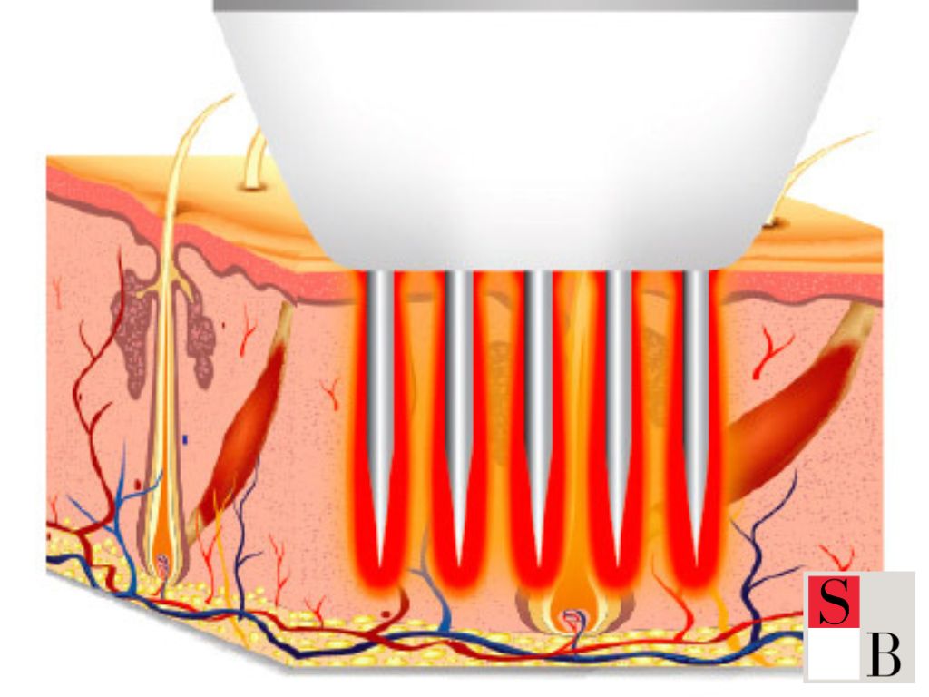 Understanding Microneedling: The Science Behind Singapore’s Glow