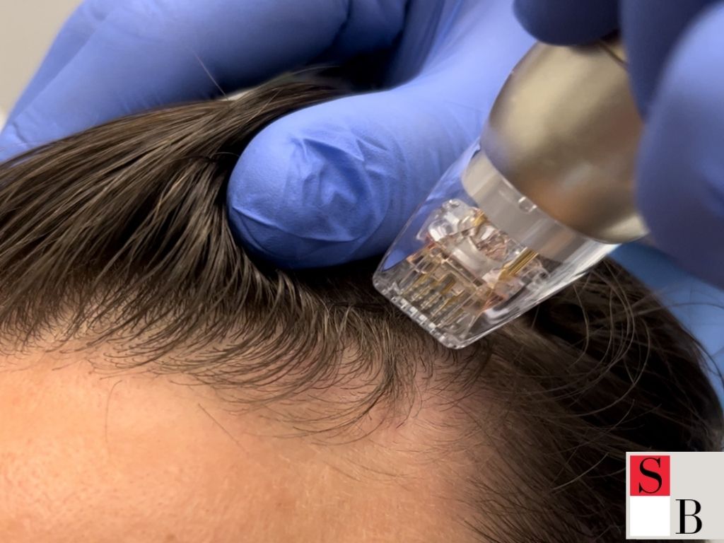 Professional Hair Regrowth Solutions in Singapore with Wellaholic