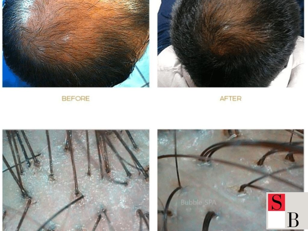 What Really Works for Hair Regrowth in Singapore