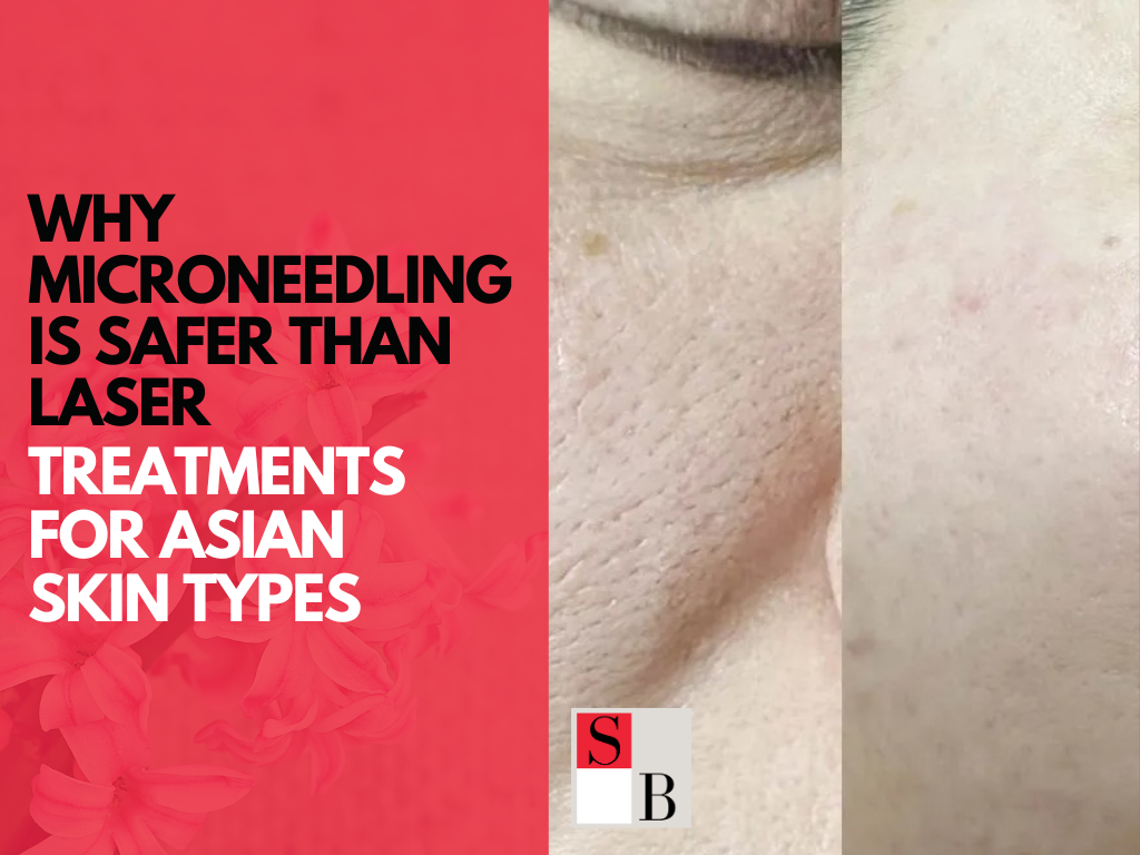 Why Microneedling is Safer Than Laser Treatments for Asian Skin Types