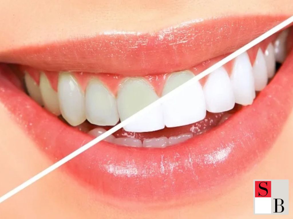 Benefits of Ayurvedic Dental Care for Whiter Teeth