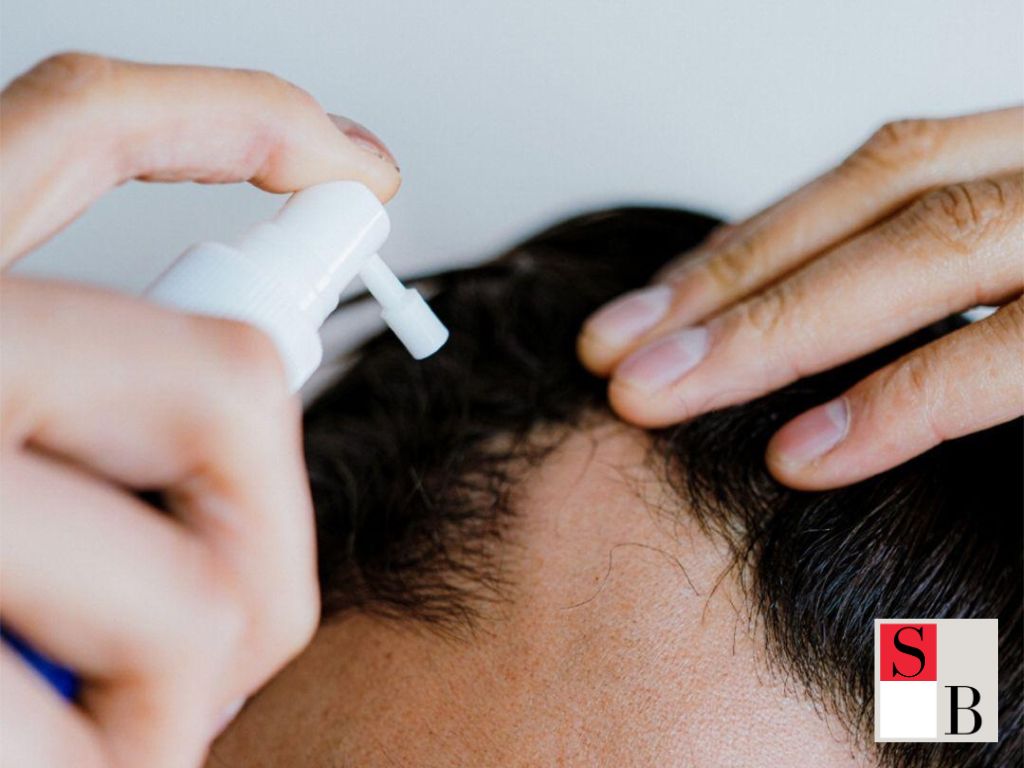 Understanding Hair Loss in Singaporean Women