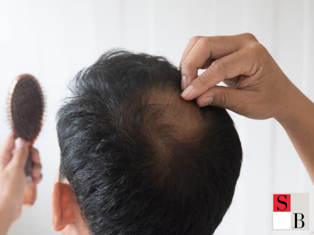 Hair Loss Myths Singapore Professionals Should Stop Believing
