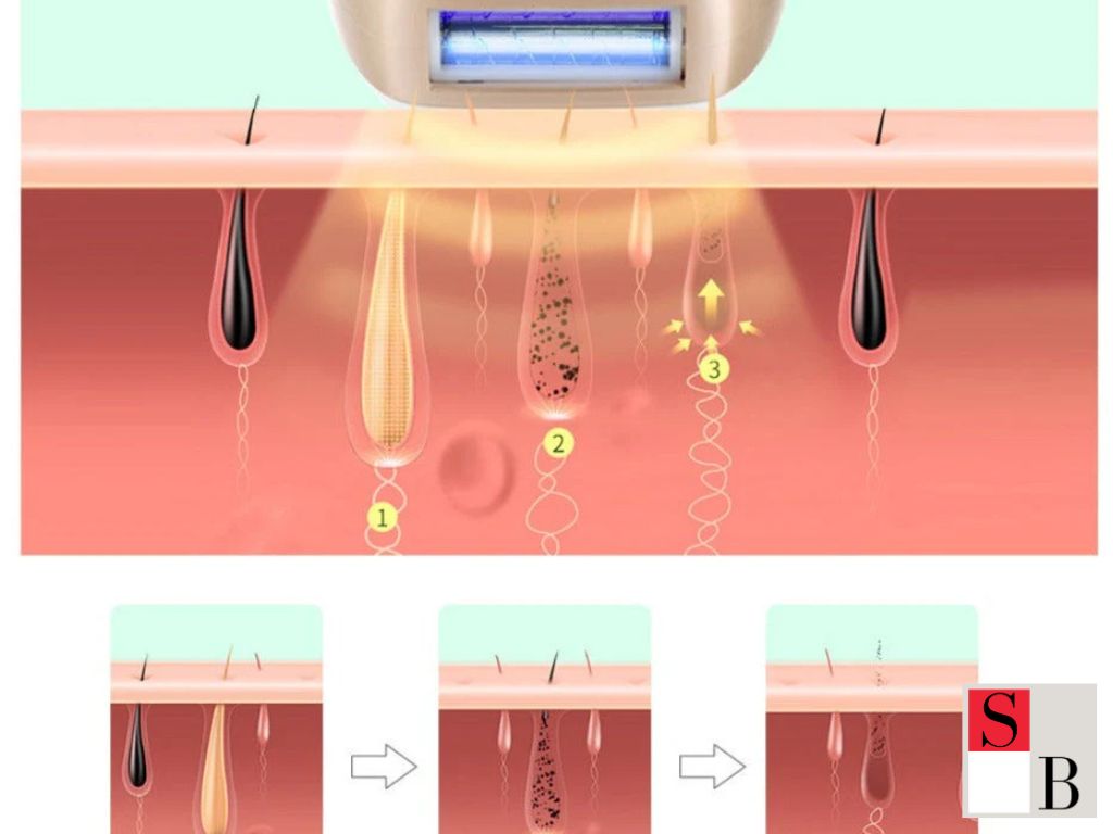 What Is Laser Hair Removal and Why It Matters in Singapore