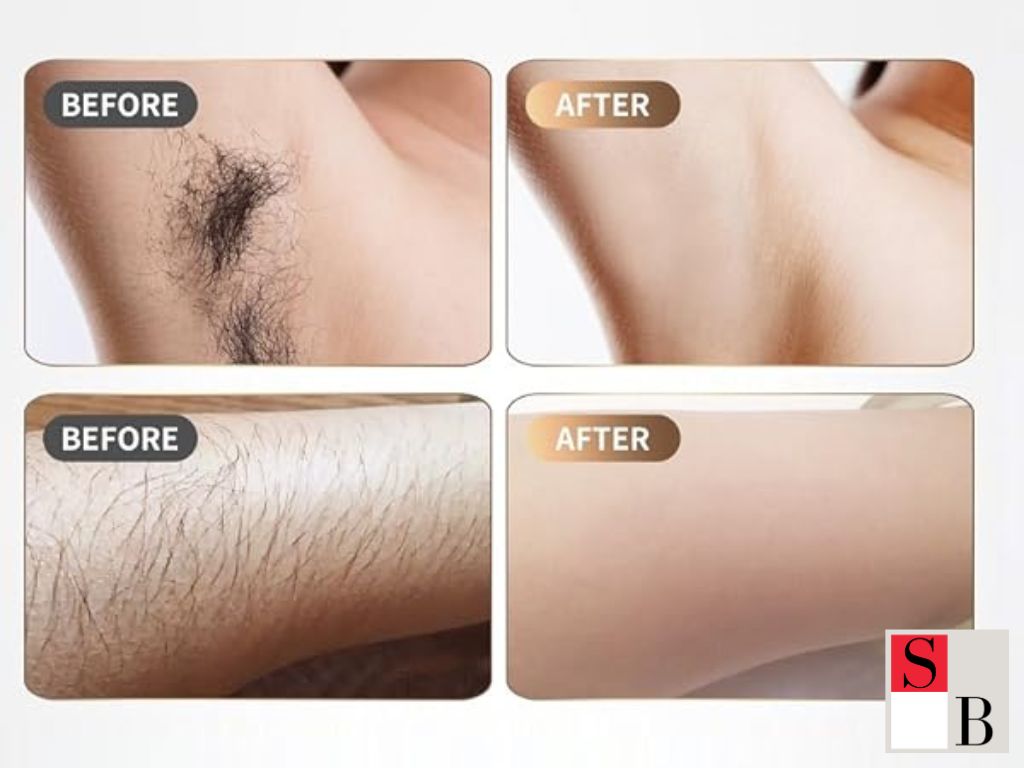 Affordable Laser Hair Removal in Singapore: Myths vs. Facts