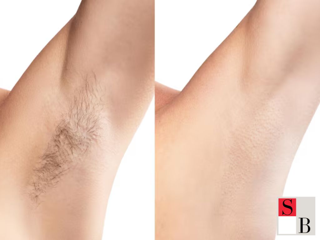 What Is Express Hair Removal in Singapore?