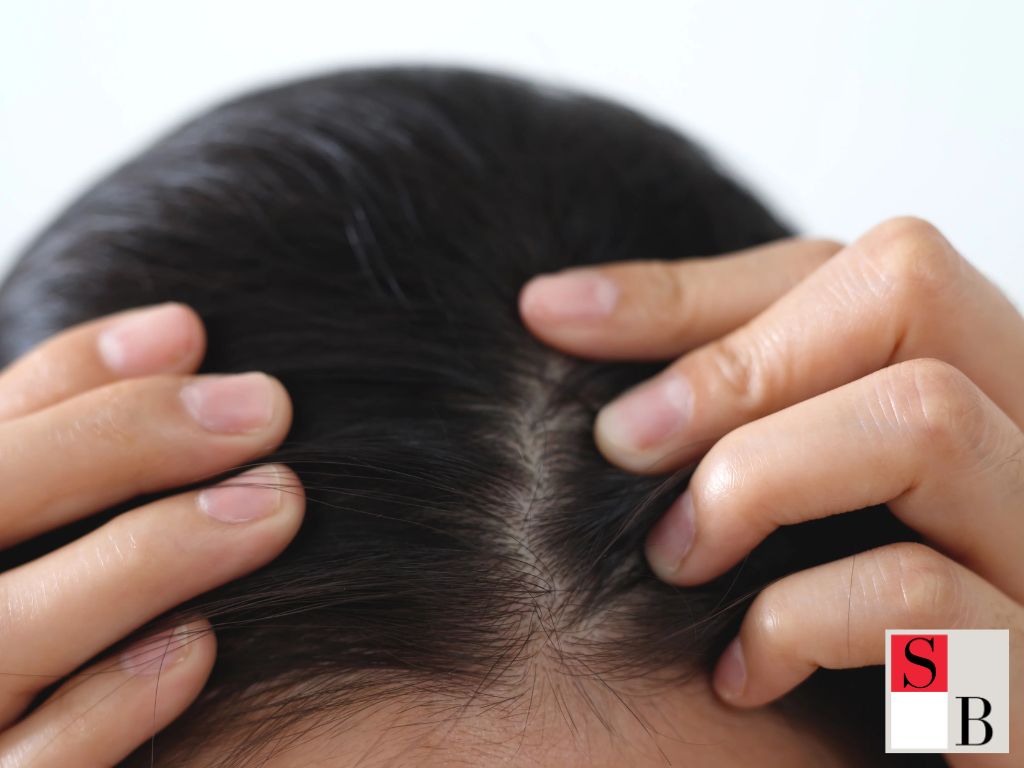 Understanding Postpartum Hair Loss in Singapore