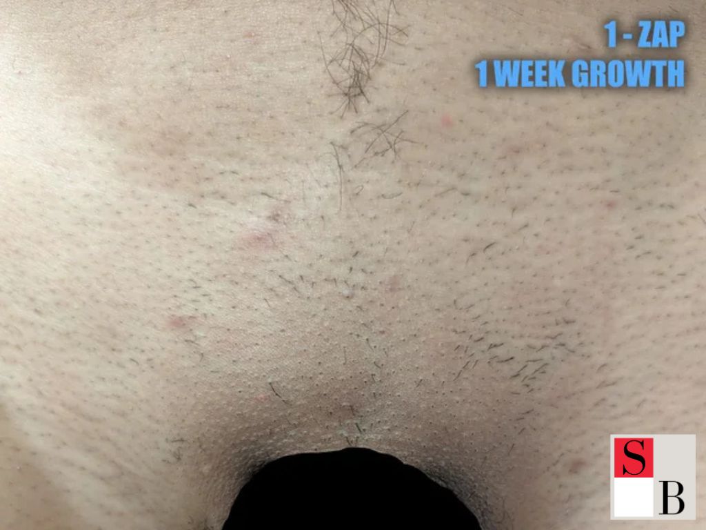 The Hygiene and Confidence Benefits of Hair Removal for Men