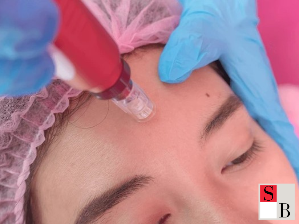 Benefits of Microneedling for Asian Skin in Singapore