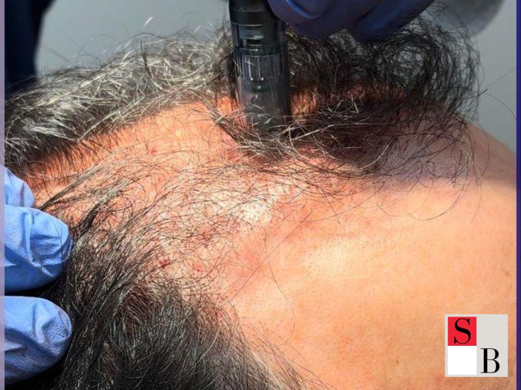 Implementing Hair Loss Solutions for Singaporean Women