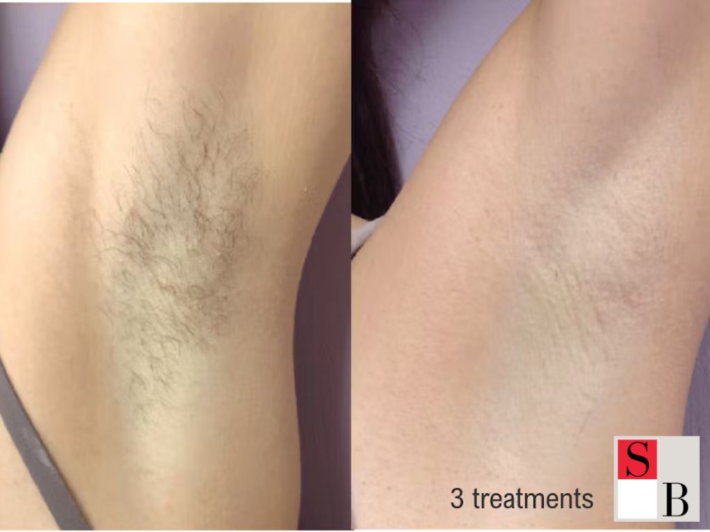 Why Choose Professional Hair Removal Near Tanjong Pagar MRT