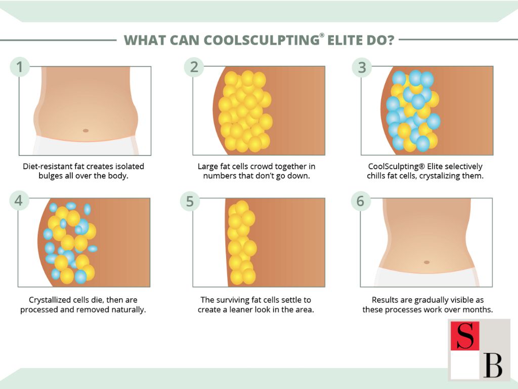 CoolSculpting Singapore: Non-Invasive Fat Reduction for Busy Professionals