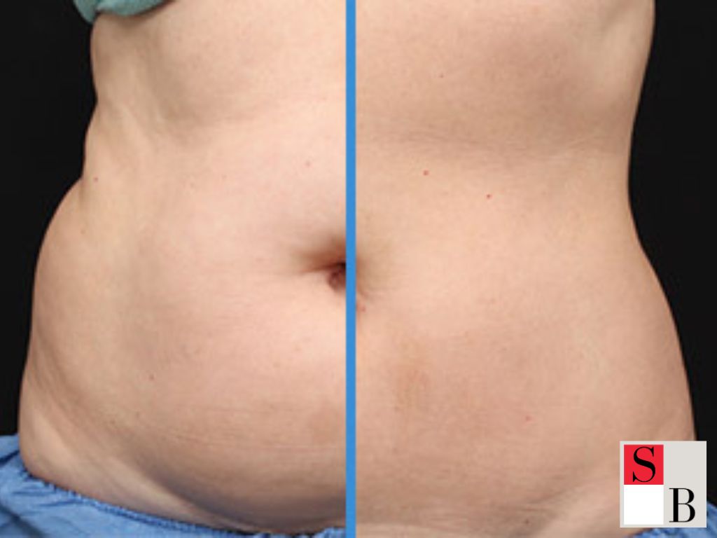 Benefits of CoolSculpting Singapore for Busy Professionals