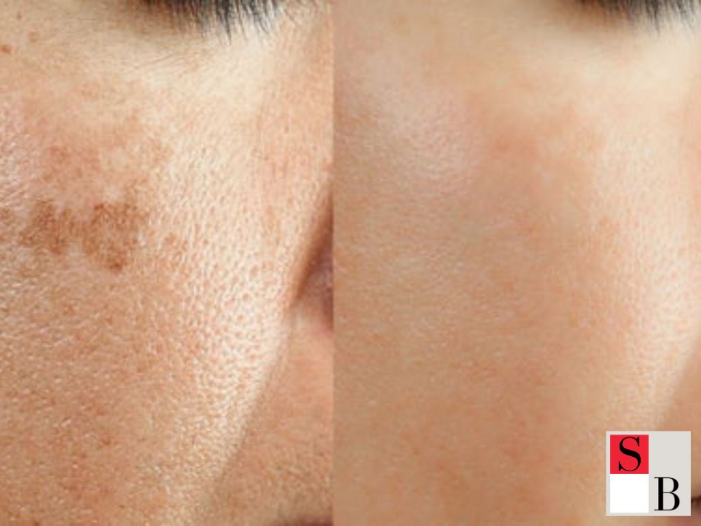 Key Benefits of Elight Facials for Singapore’s Humid Climate