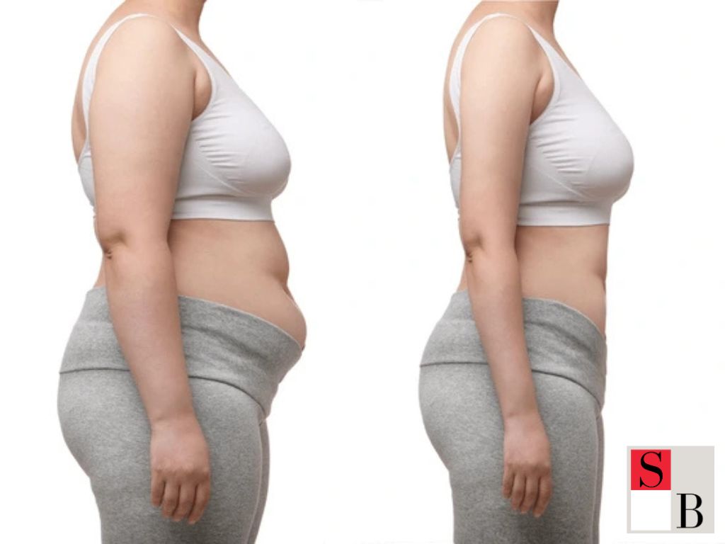 Benefits of Skin Tightening While Slimming