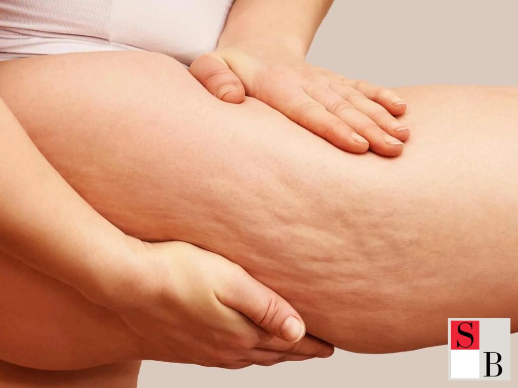 Understanding Cellulite: Causes and Context in Singapore