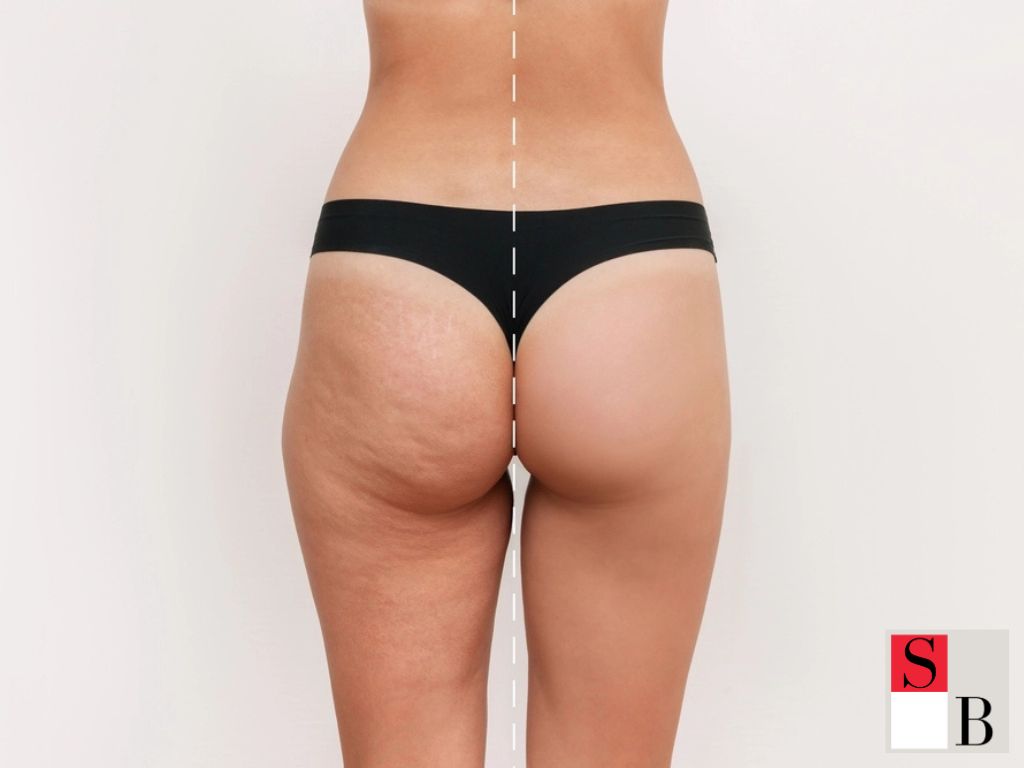 Proven Benefits of Targeted Cellulite Treatments
