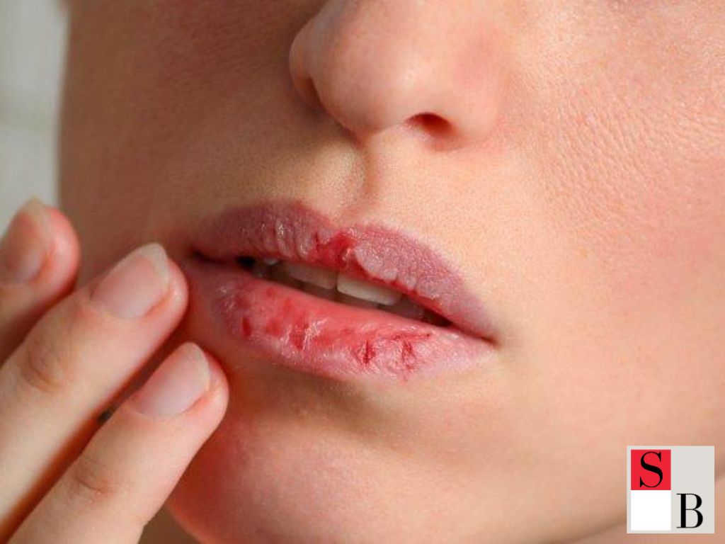 Understanding Lip Health in Singapore’s Climate