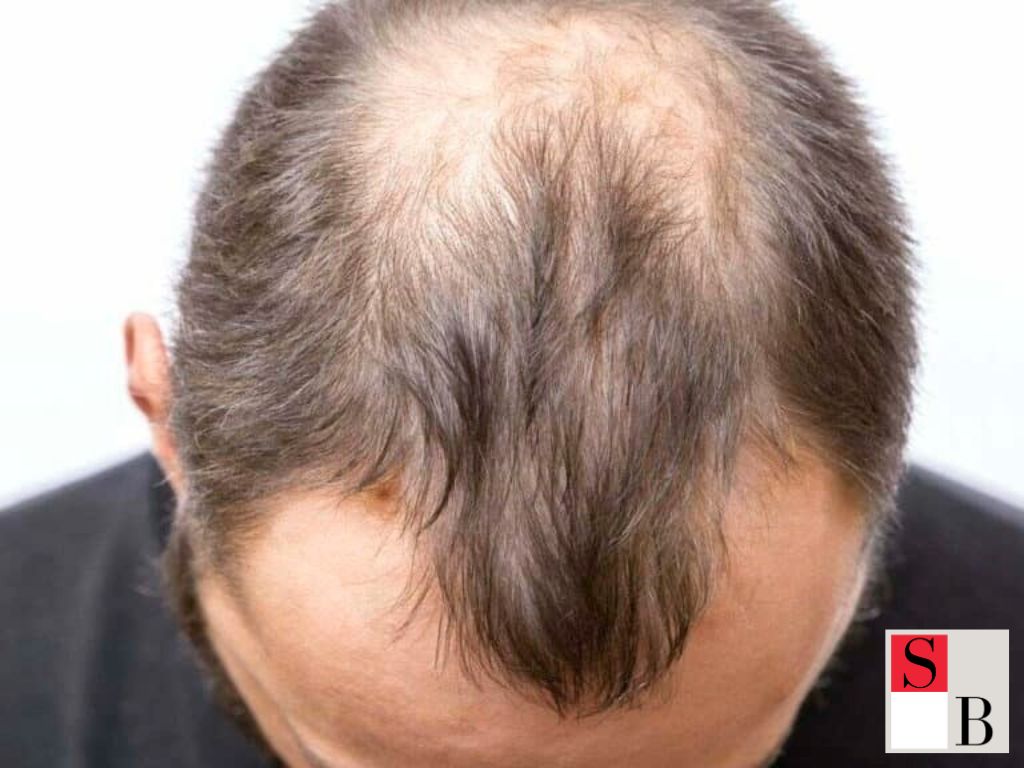 The Benefits of Understanding Male Pattern Baldness