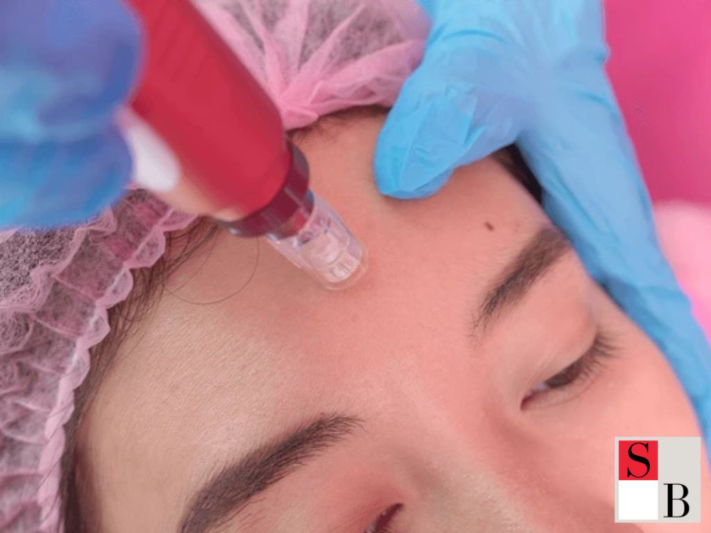 What Is Microneedling and Why It Matters for Singapore Skin