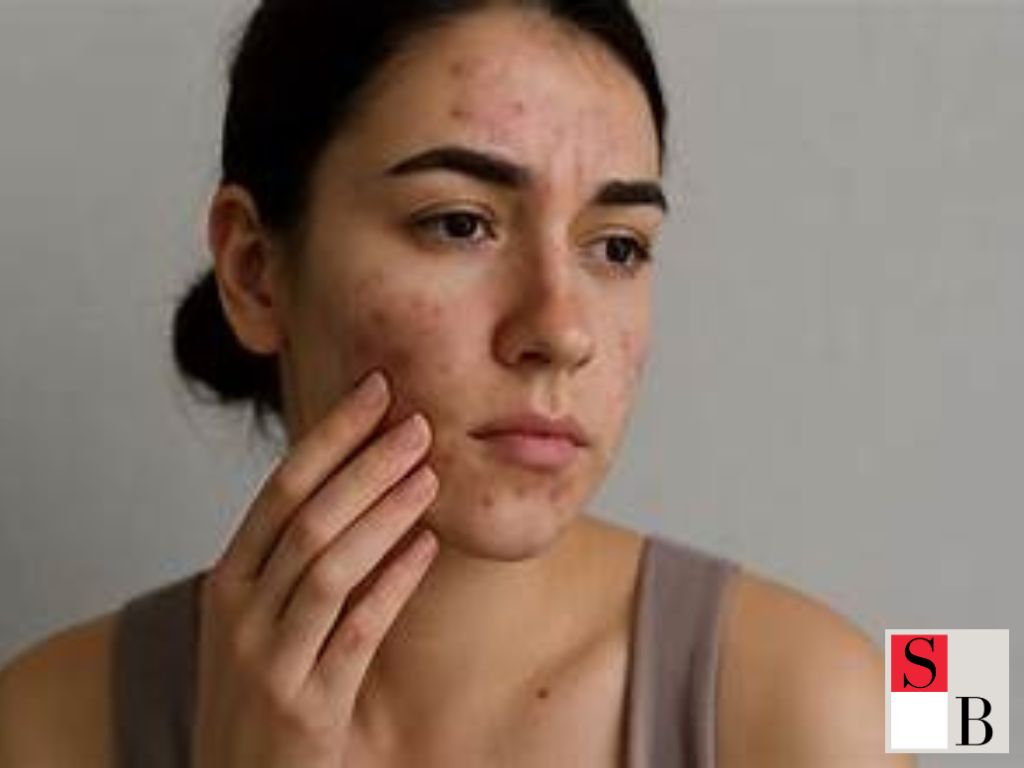 How to Choose Acne Treatment Clinics Near Somerset MRT Station