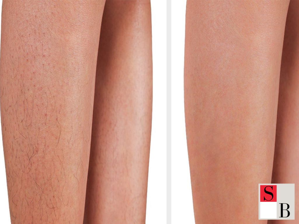 Why Choose Pain-Free Laser Hair Removal?