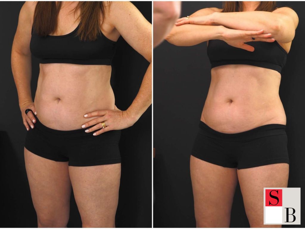 Benefits of Non-Invasive Body Contouring in Singapore