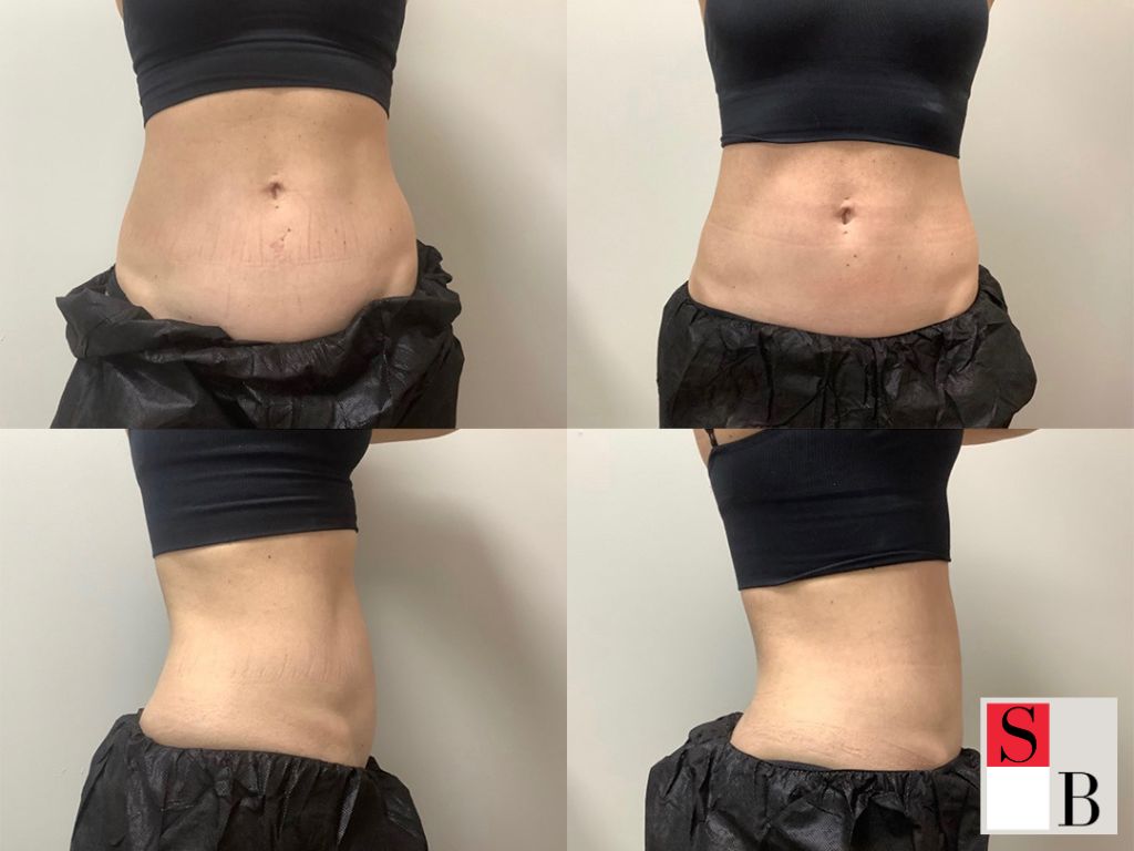 Benefits of Body Sculpting for Southeast Asian Beauty