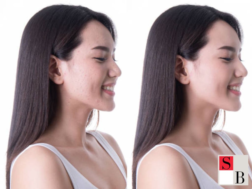 Benefits of Botox-Alternative Facials in Singapore