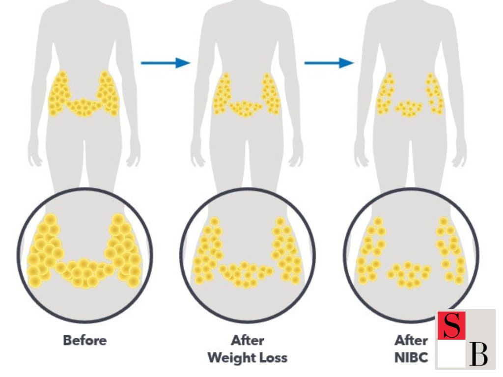 What is Body Sculpting in Singapore?