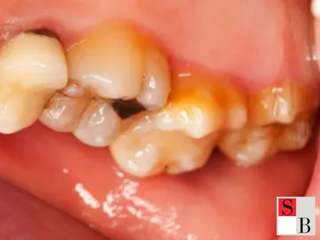 Why Bubble Tea Causes Greater Teeth Damage in Asia