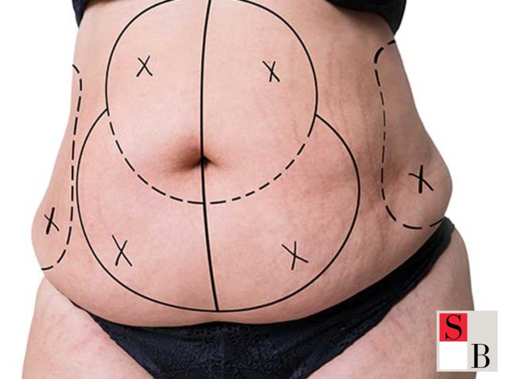 Recovery-Free Slimming in Singapore: Core Concept