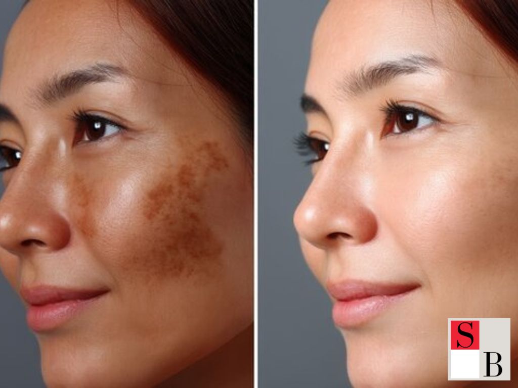 Best Times for RF Microneedling in Singapore