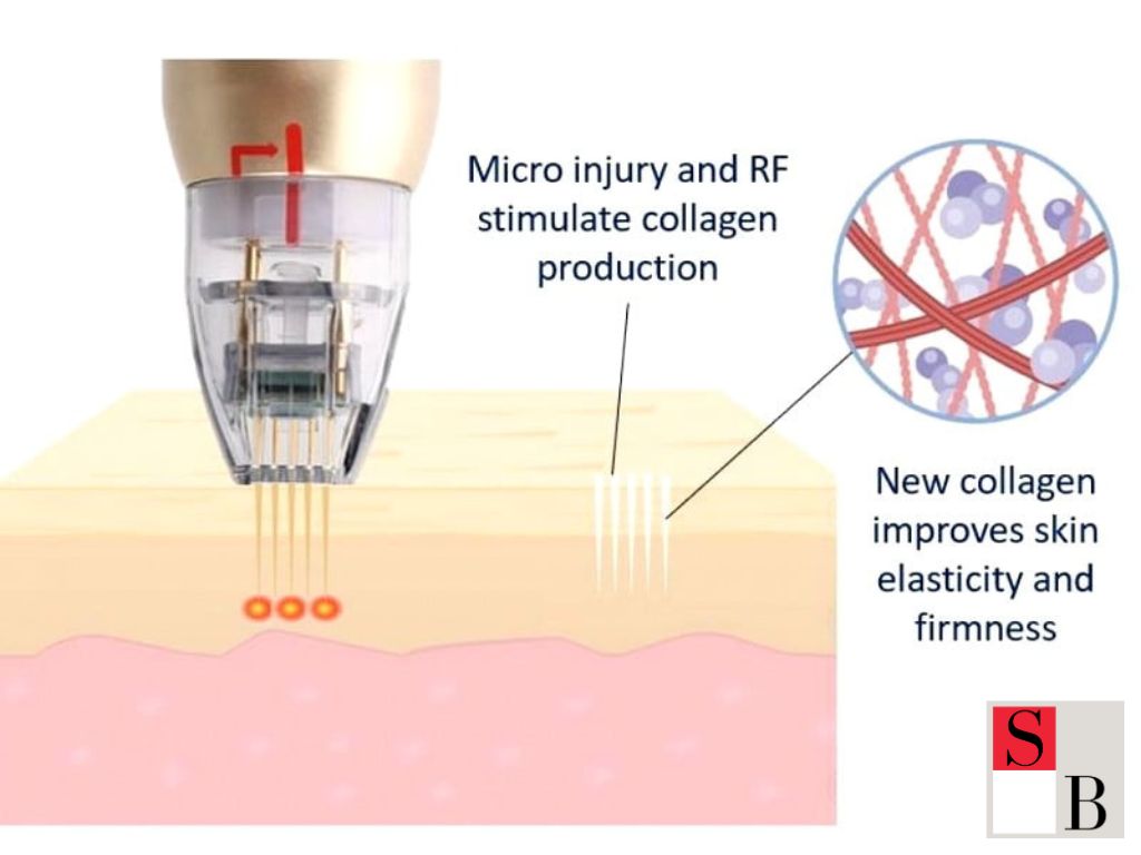 What is RF Microneedling in Singapore?