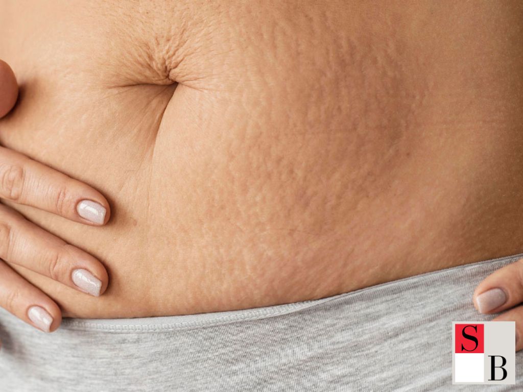 Advanced Microneedling Benefits for Post-Pregnancy Skin