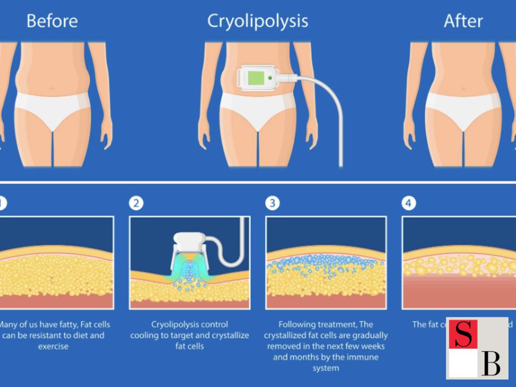 Benefits of Fat Freezing Technologies in Singapore