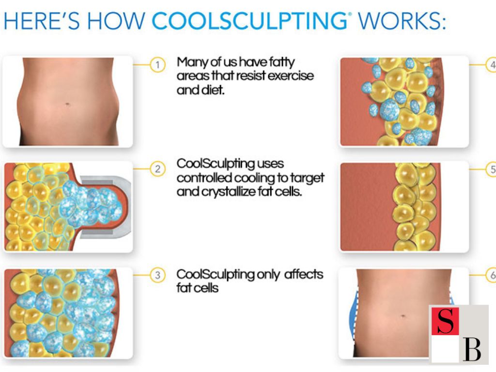 Understanding Fat Freezing in Singapore