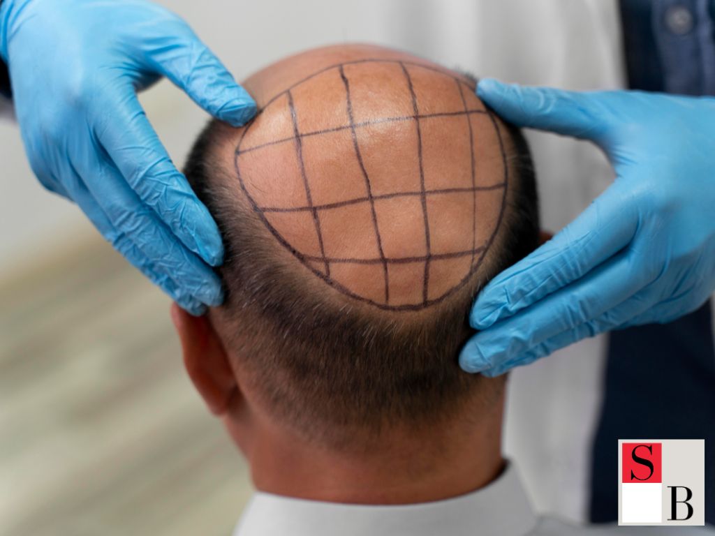 Why Address Hair Loss Early Matters in Singapore