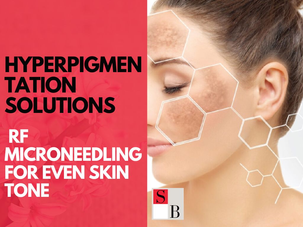 Hyperpigmentation Solutions: RF Microneedling for Even Skin Tone