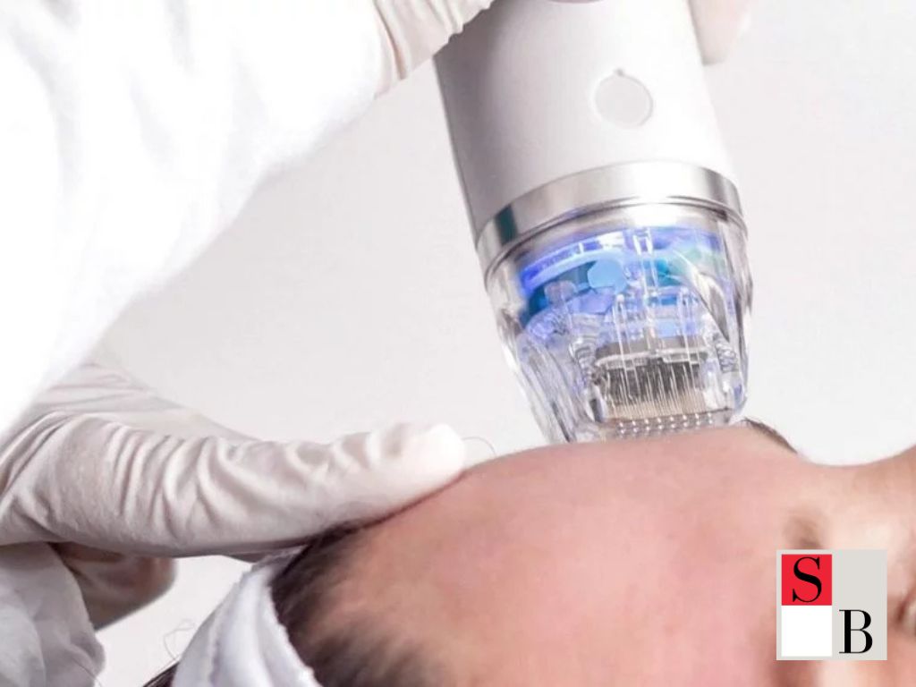 What to Expect from RF Microneedling Treatment in Singapore