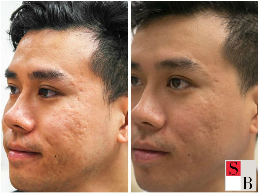 Benefits of Microneedling for Men in Singapore