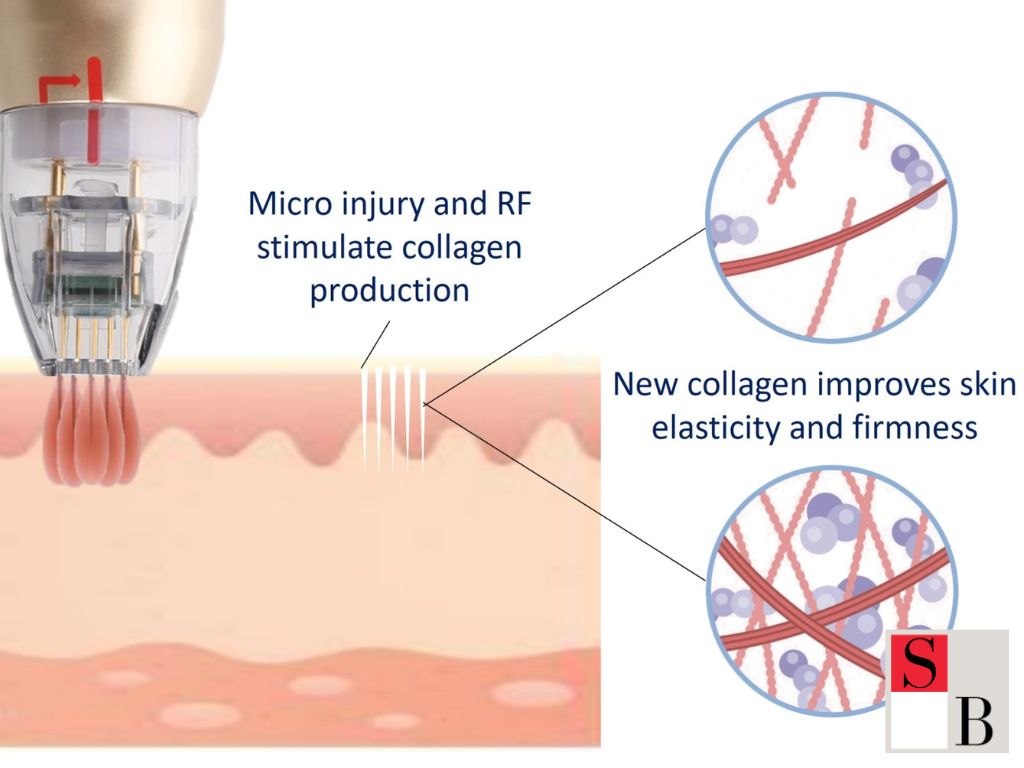 Microneedling for Men in Singapore: Understanding the Core Concept