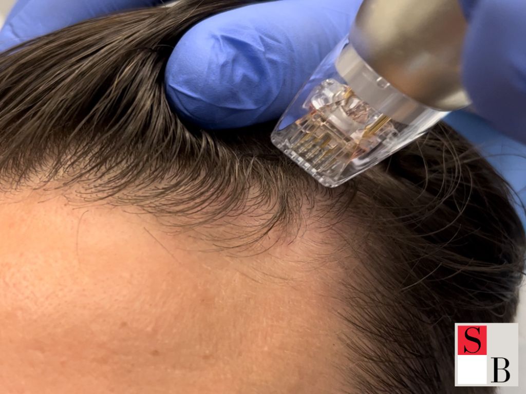 Professional Hair Growth Treatments with Wellaholic in Singapore