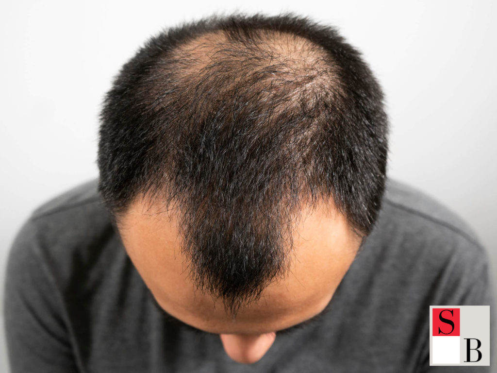 Why Addressing Hair Loss Boosts Career Confidence