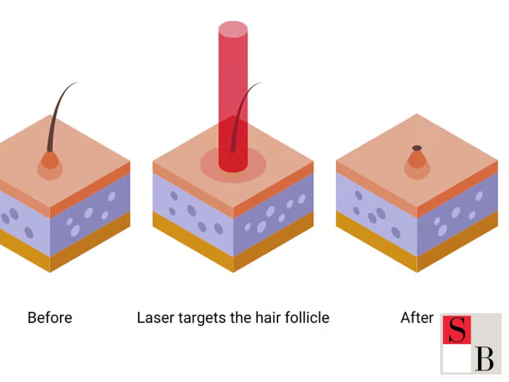 Premium Hair Removal Singapore: Core Concept