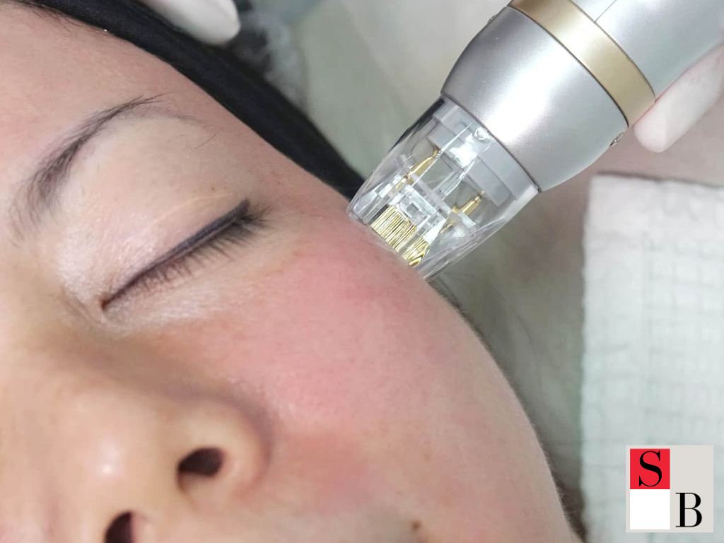 Benefits of Facial Rejuvenation for Southeast Asian Skin