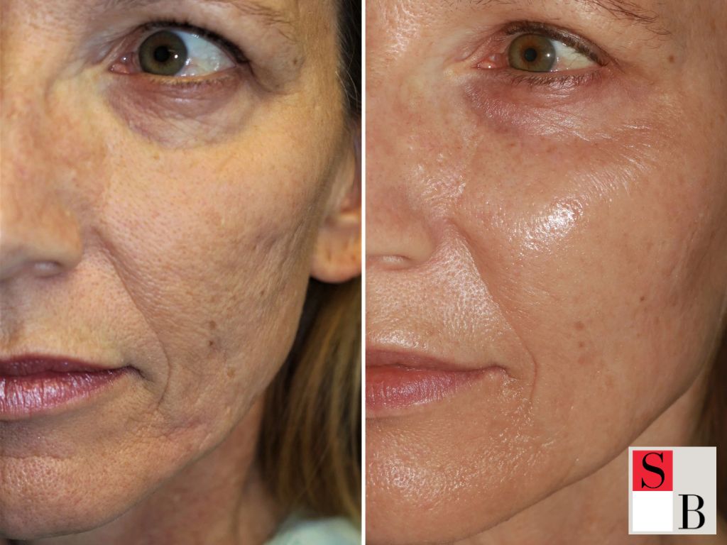 Best Age to Start Microneedling: Understanding the Core Concept