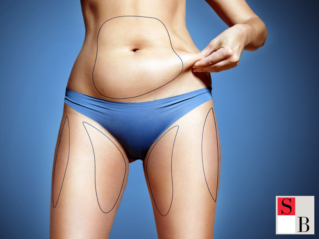 Key Benefits of CoolSculpting Alternatives Near Somerset MRT